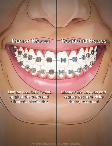 bracket damon metal|damon braces pros and cons.